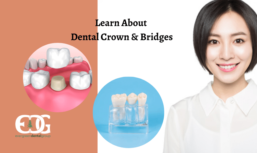 Learn About Dental Crown & Bridges